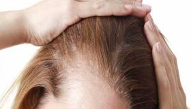 أفضل العلاجات المنزلية لحل مشكلة ترقق الشعر